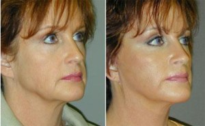 facelift before and after photo