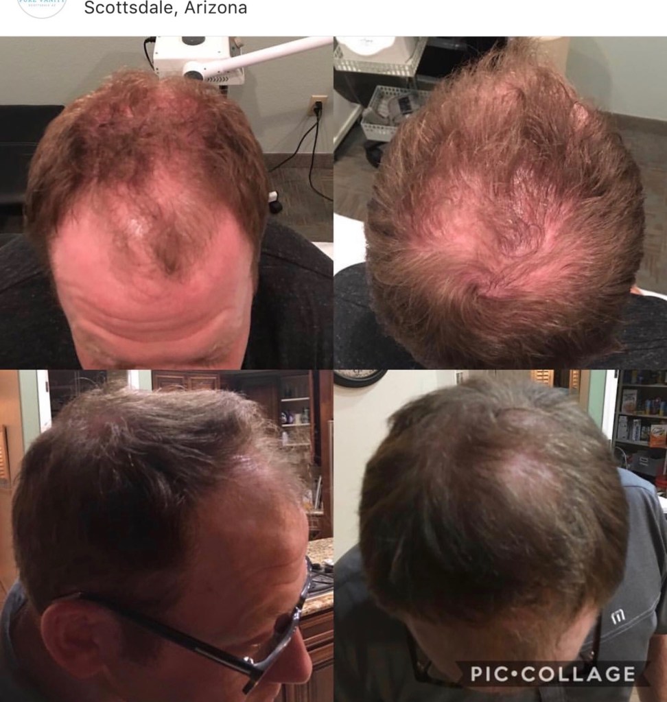 Male patient before (above ) and 6 weeks after 1st Epifix injection